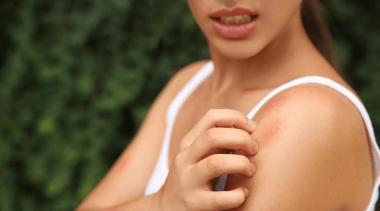 A woman scratching a mosquito bite for itch relief