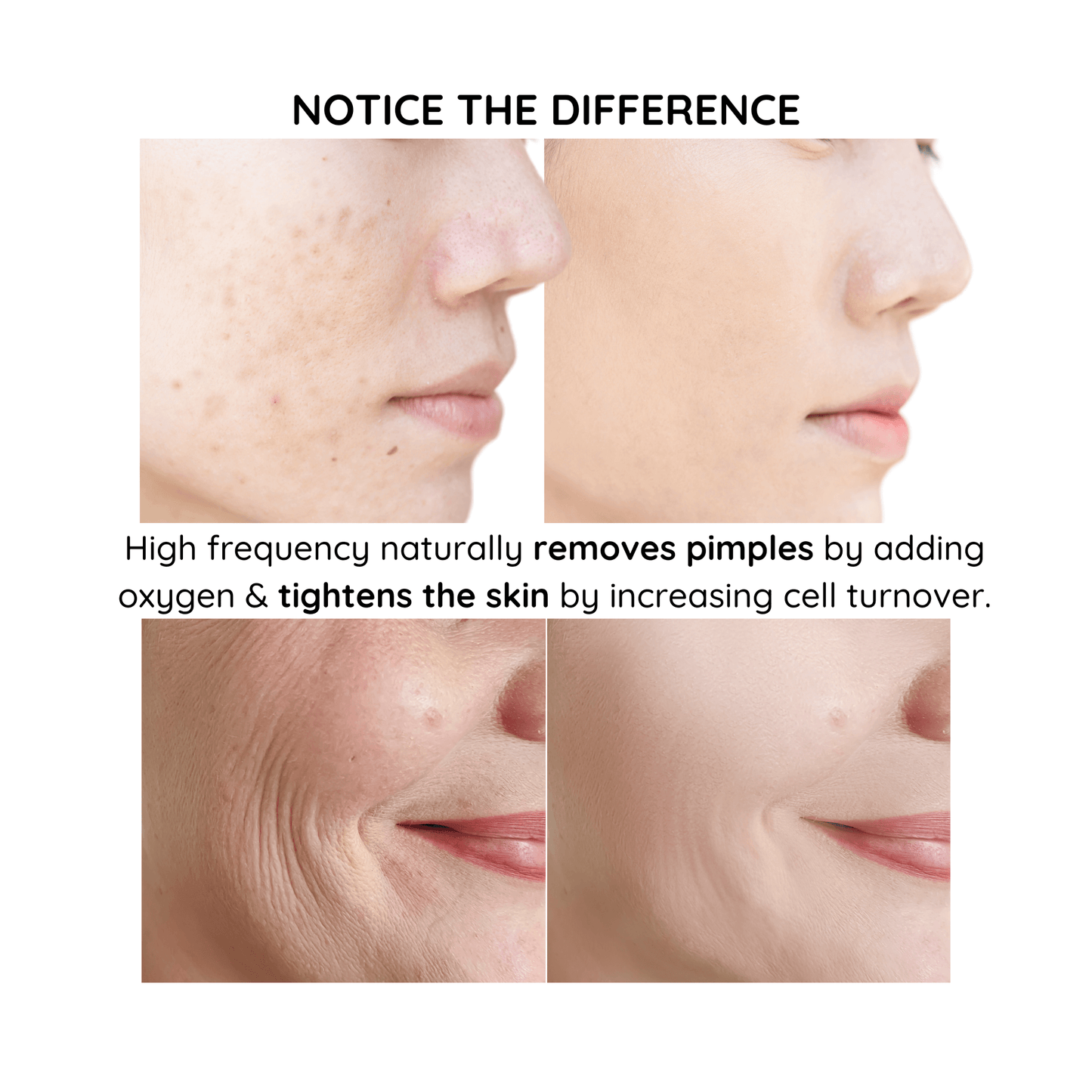 high frequency wand before and after photos of a smiling womans face showing effective pimple reduction and fine line reduction