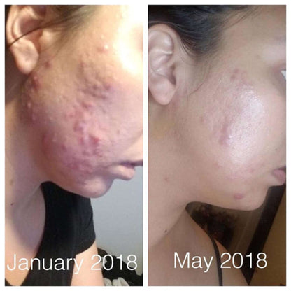 organic pimple treatment 4 month before after photo acne reduction