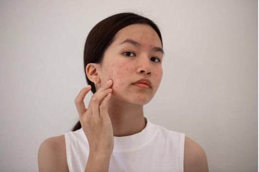 K-Beauty Skincare for Acne-Prone Skin Top 5 Ingredients