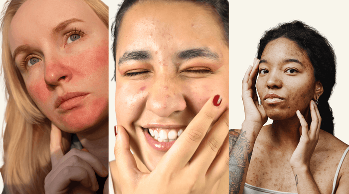Women with acne sensitive acne prone skin are touching their faces